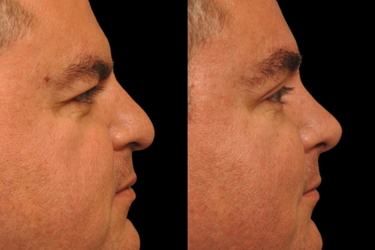 Rhinoplasty For Men Before & After Gallery - Patient 325074 - Image 6