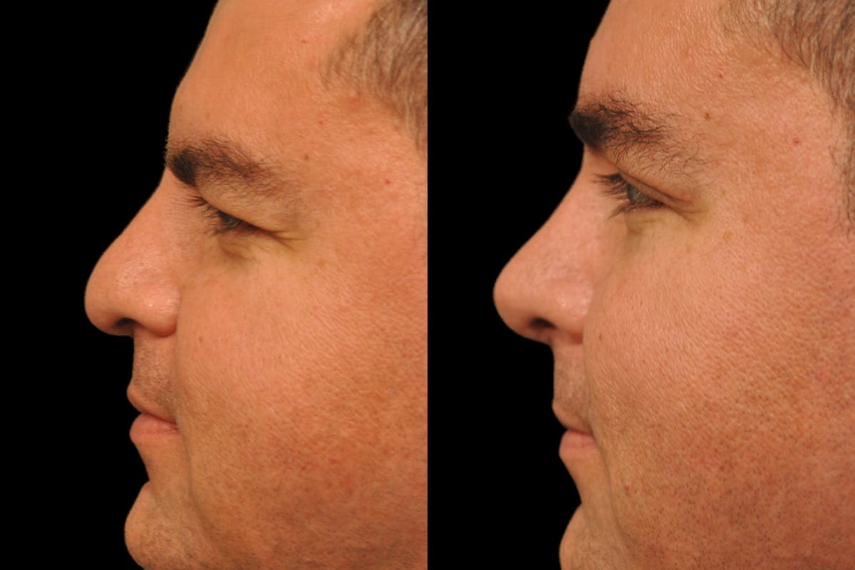 Rhinoplasty For Men Before & After Gallery - Patient 325074 - Image 3
