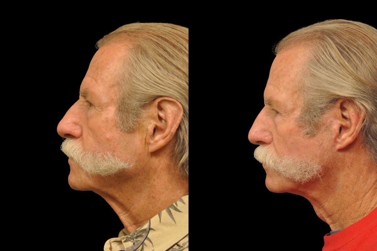 Changes Rapid Lift For Men Before & After Gallery - Patient 192277 - Image 2