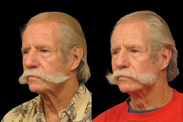 Changes Rapid Lift For Men Before & After Gallery - Patient 192277 - Image 1