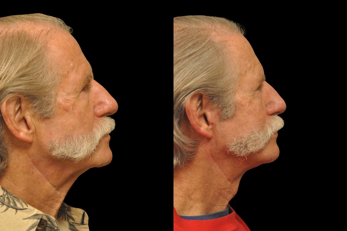 Changes Rapid Lift For Men Before & After Gallery - Patient 192277 - Image 4