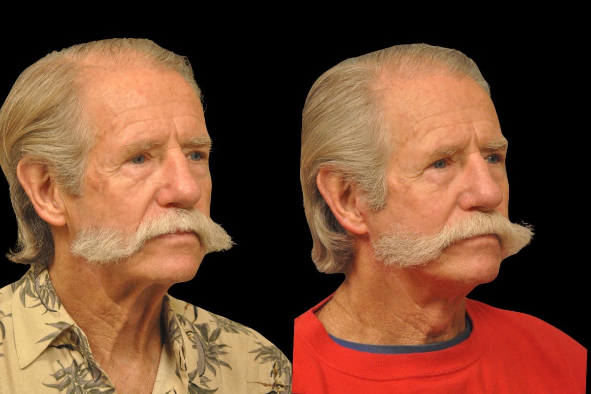 Changes Rapid Lift For Men Before & After Gallery - Patient 192277 - Image 3