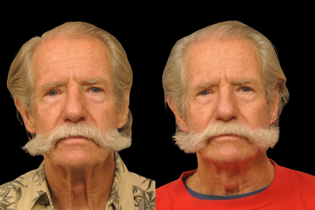 Changes Rapid Lift For Men Before & After Gallery - Patient 192277 - Image 5