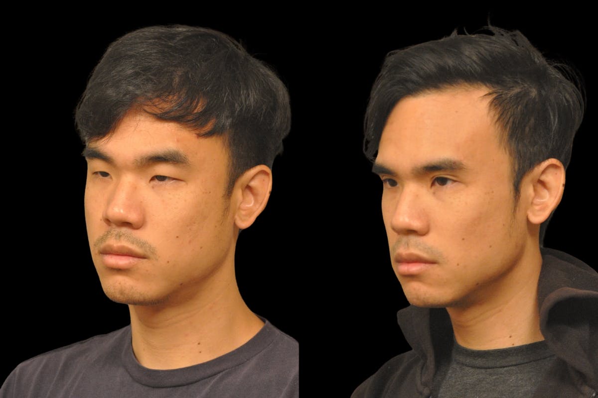 Asian Double Fold Before & After Gallery - Patient 709361 - Image 1