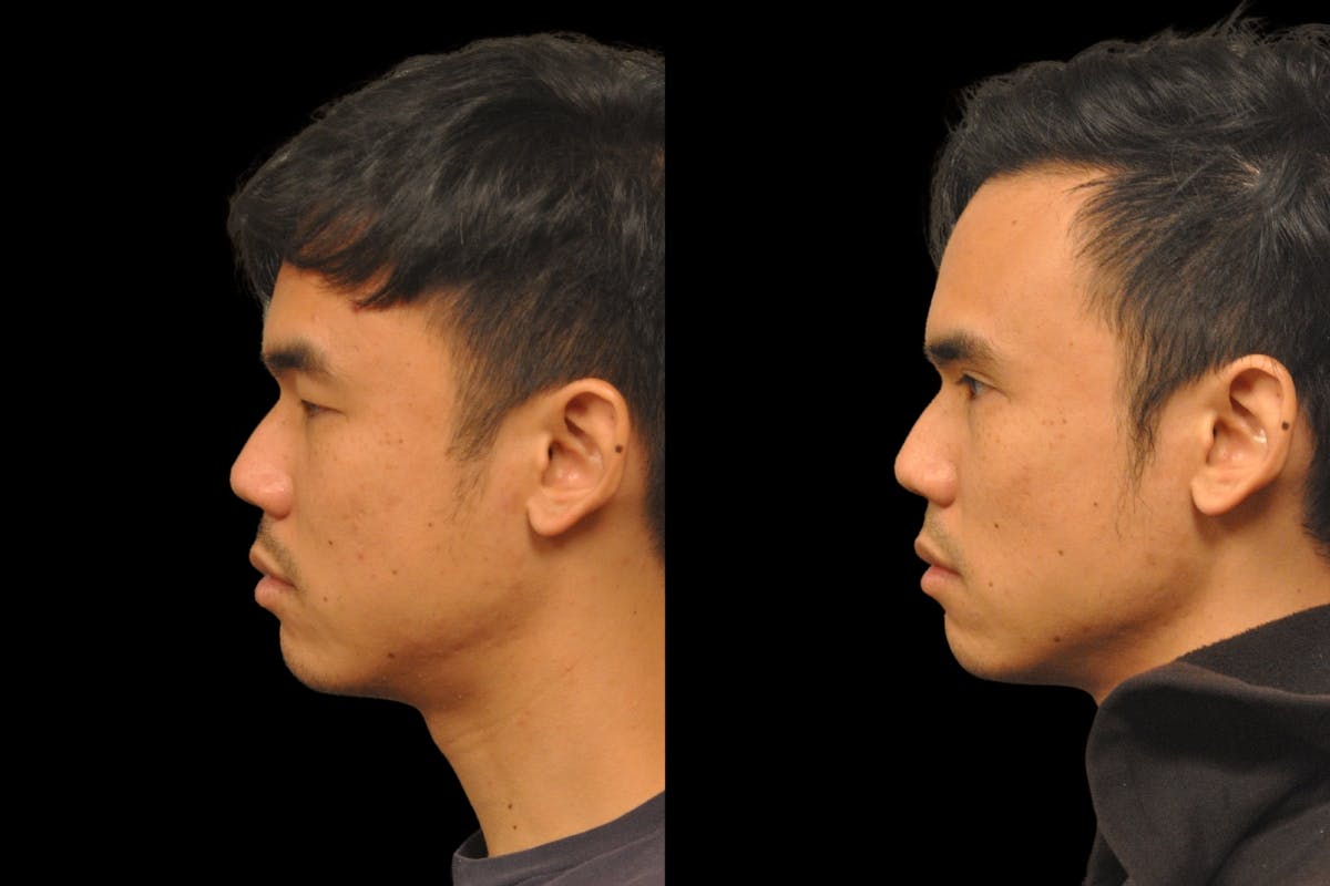 Asian Double Fold Before & After Gallery - Patient 709361 - Image 2