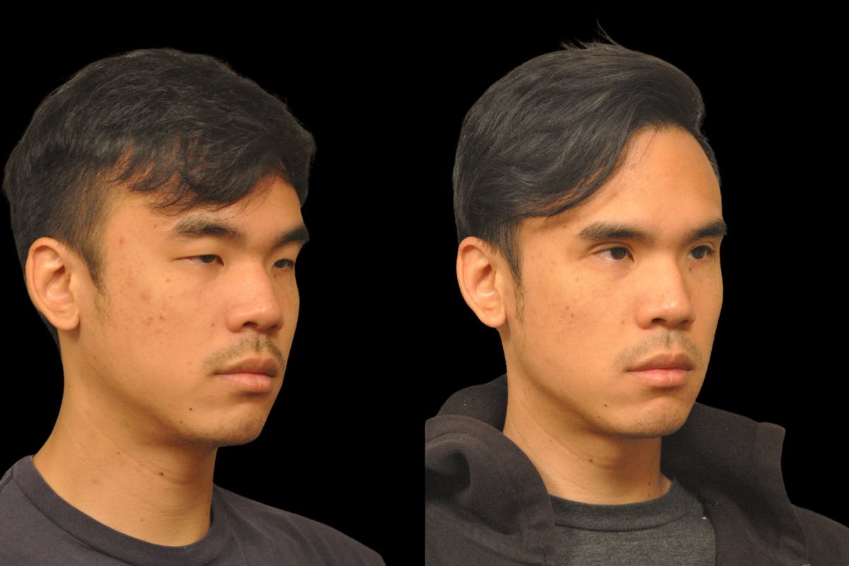 Asian Double Fold Before & After Gallery - Patient 709361 - Image 3