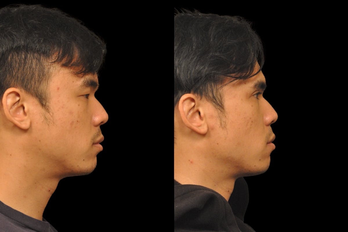 Asian Double Fold Before & After Gallery - Patient 709361 - Image 4