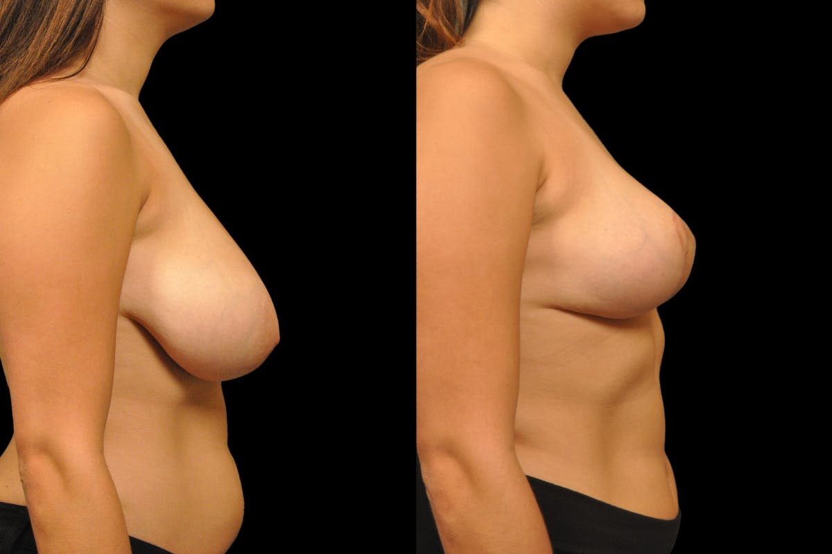Breast Reduction Before & After Gallery - Patient 209591 - Image 5
