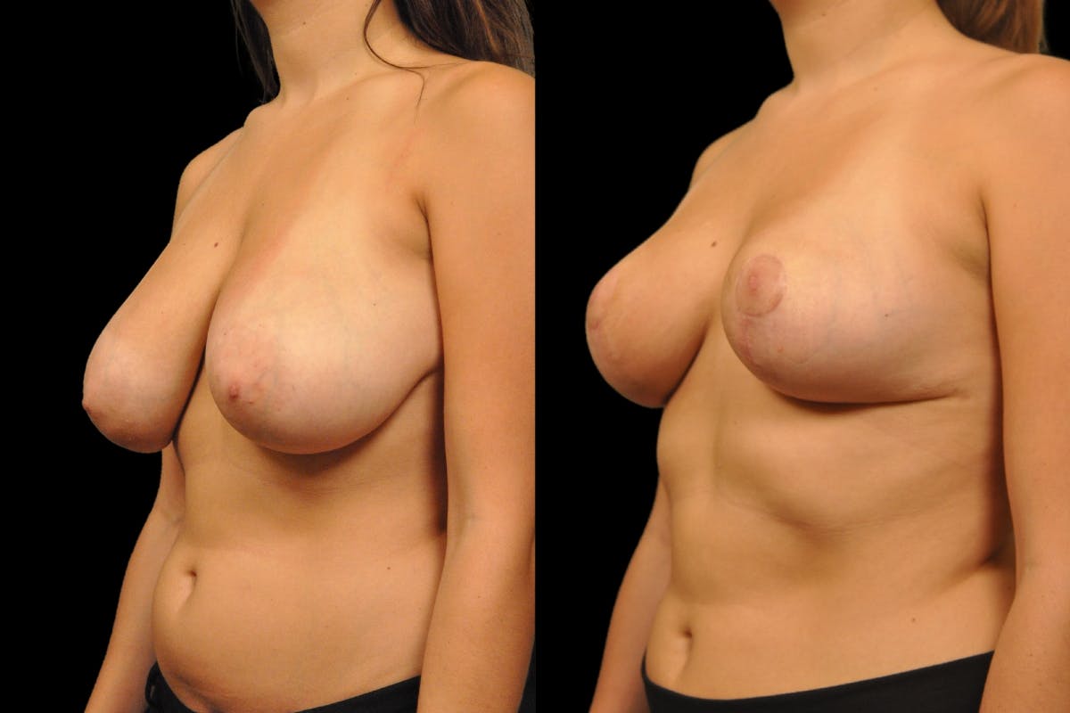 Breast Reduction Before & After Gallery - Patient 209591 - Image 2