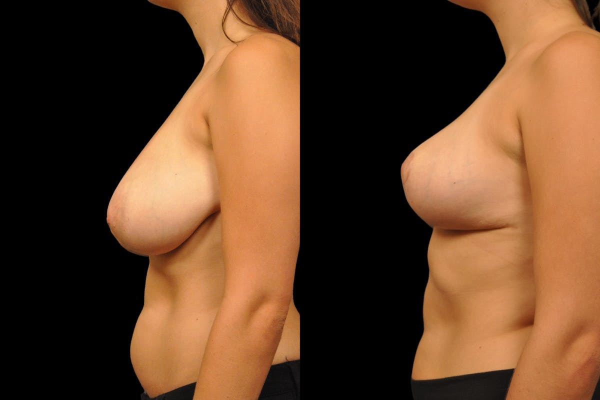 Breast Reduction Before & After Gallery - Patient 209591 - Image 3