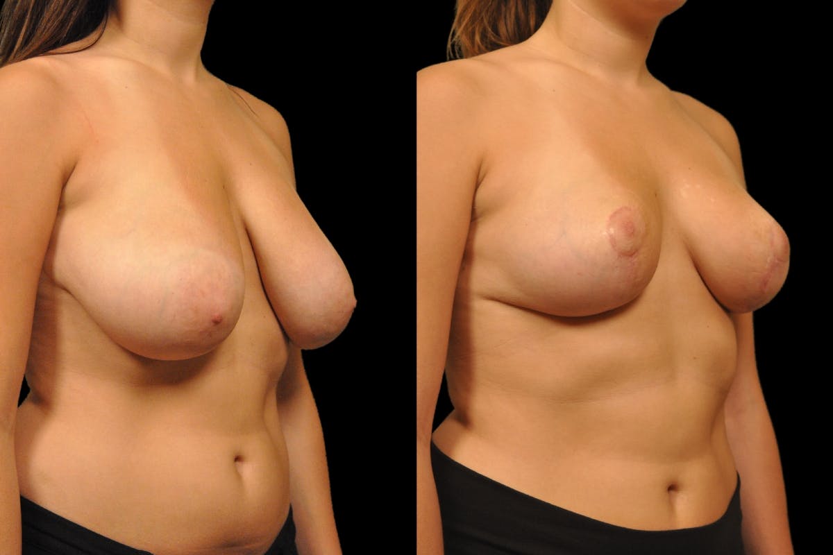 Breast Reduction Before & After Gallery - Patient 209591 - Image 4