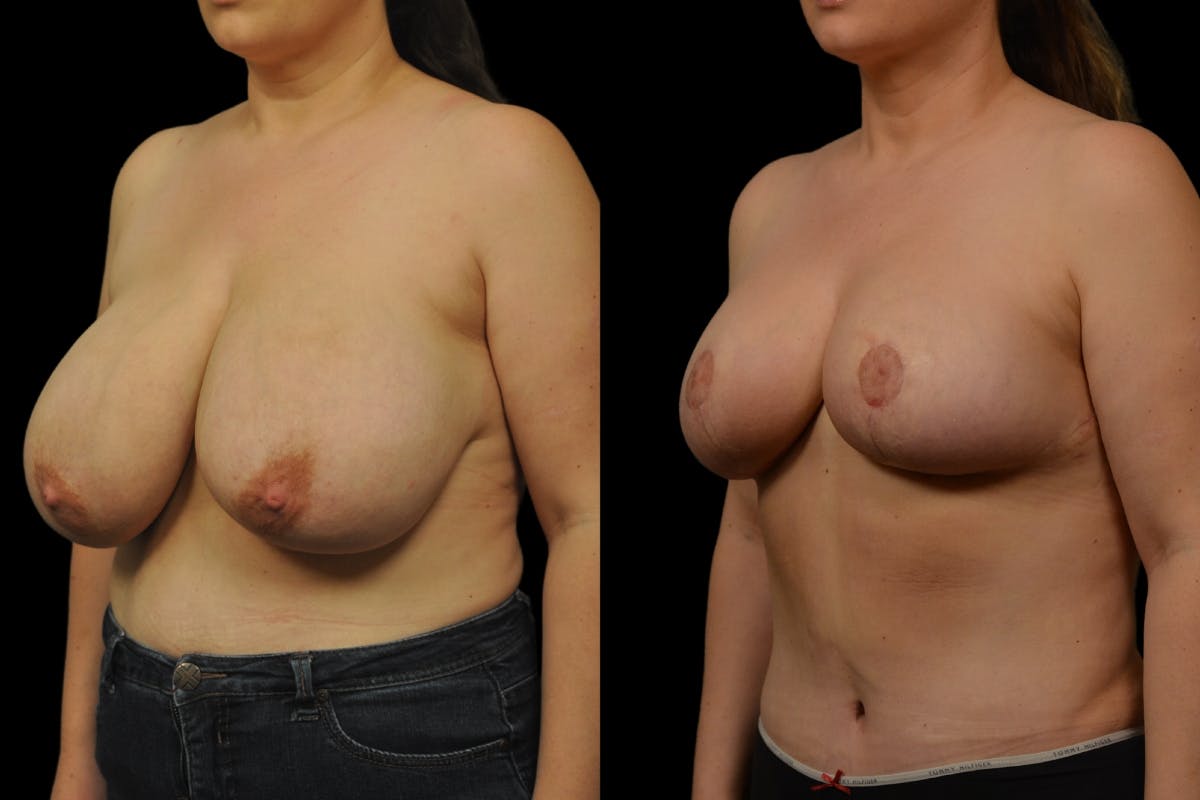 Breast Reduction Before & After Gallery - Patient 872575 - Image 2