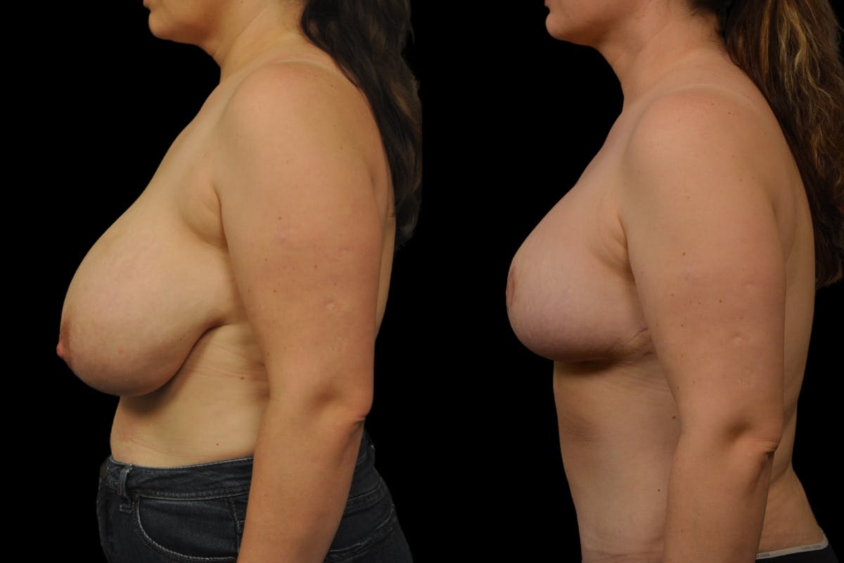 Breast Reduction Before & After Gallery - Patient 872575 - Image 3