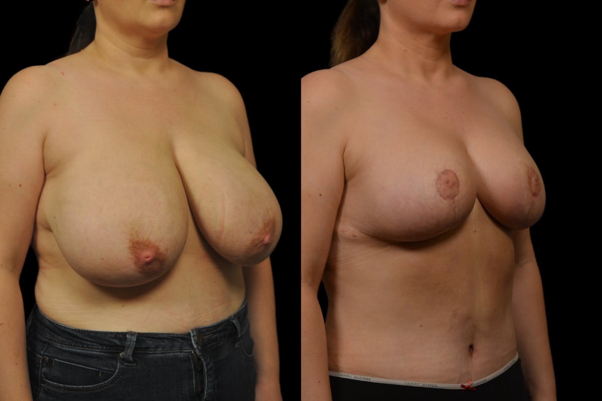 Breast Reduction Before & After Gallery - Patient 872575 - Image 4