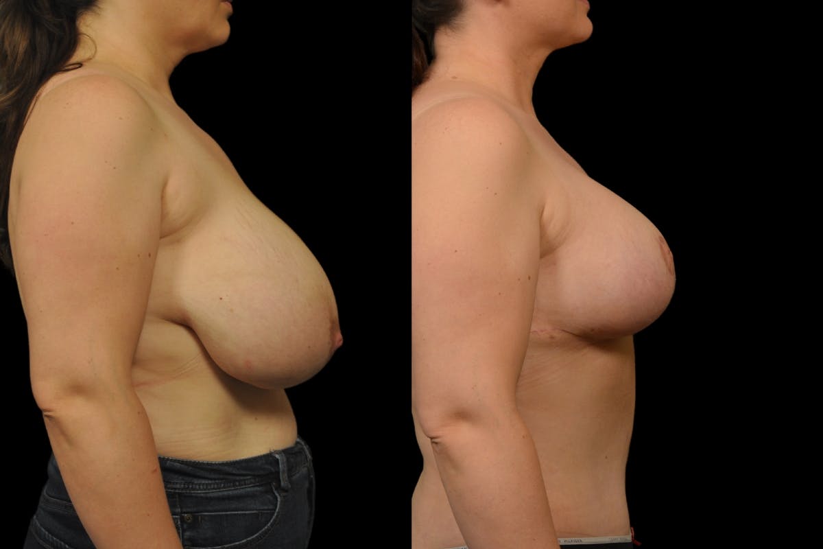 Breast Reduction Before & After Gallery - Patient 872575 - Image 5