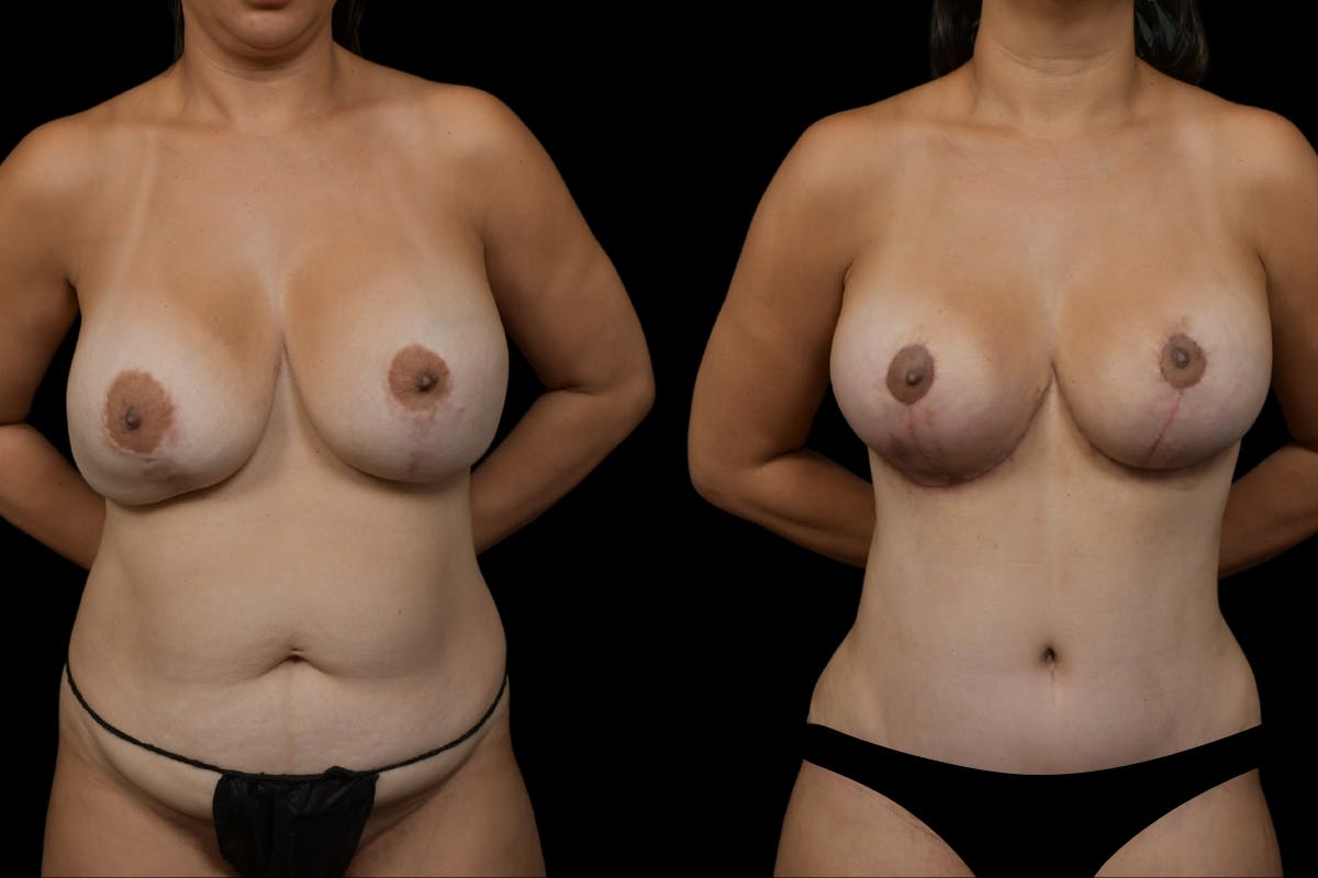 Breast Lift Before & After Gallery - Patient 372219 - Image 1