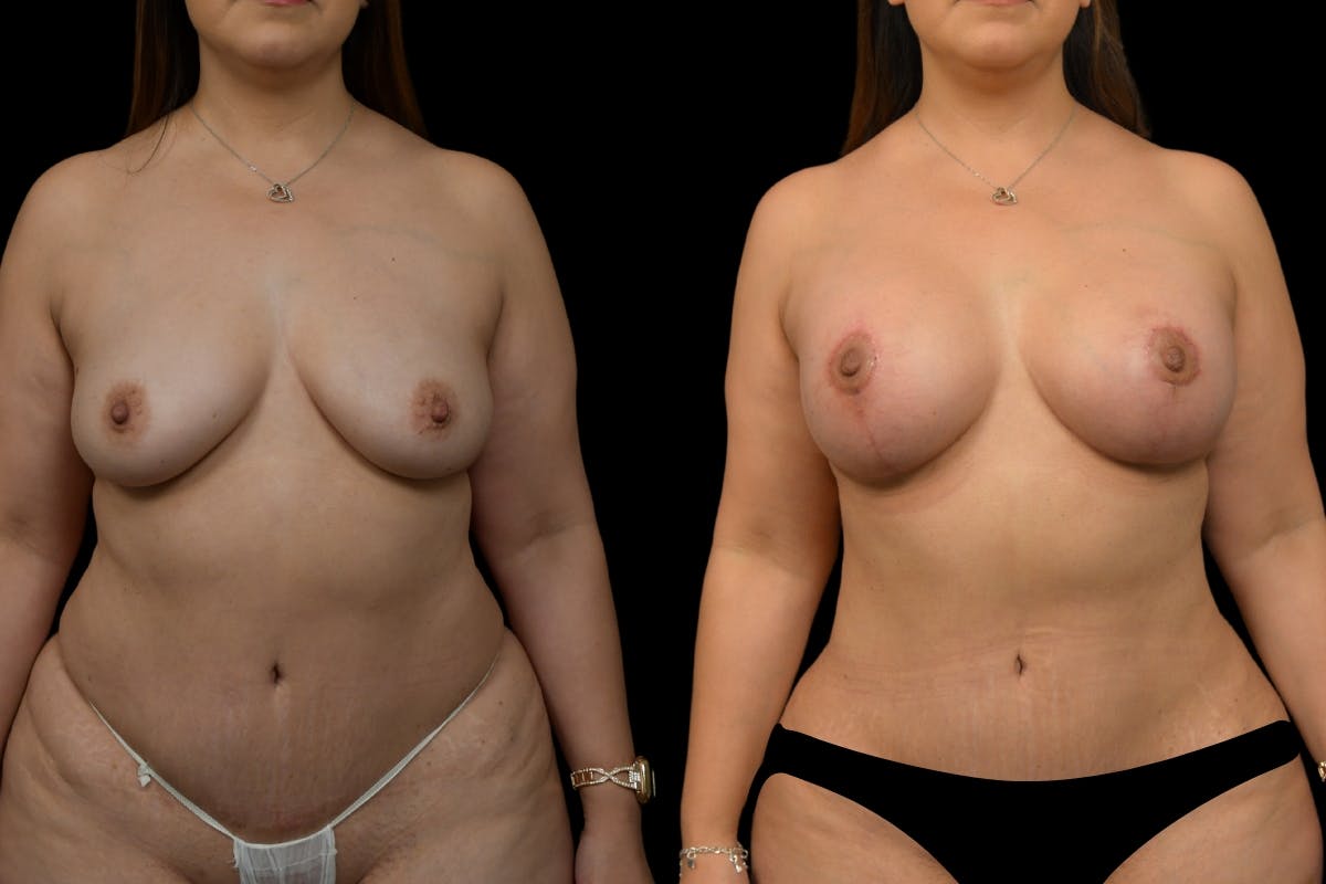 Breast Lift Before & After Gallery - Patient 135089 - Image 1