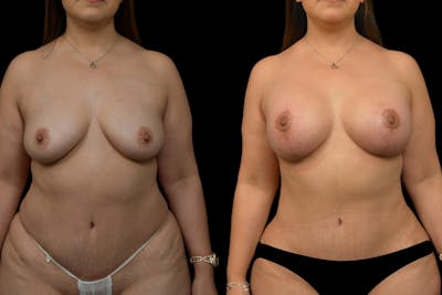 Reductive Augmentation Before & After Gallery - Patient 884523 - Image 1