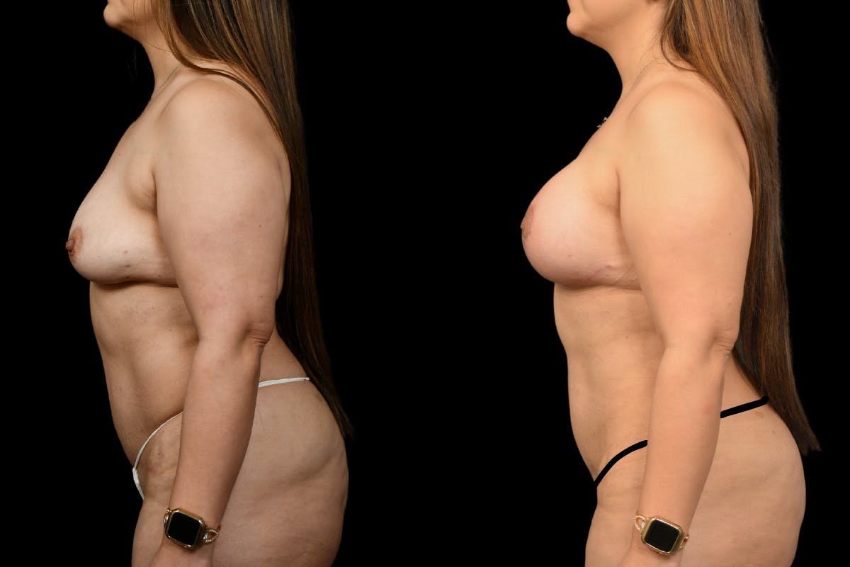 Breast Lift Before & After Gallery - Patient 135089 - Image 5