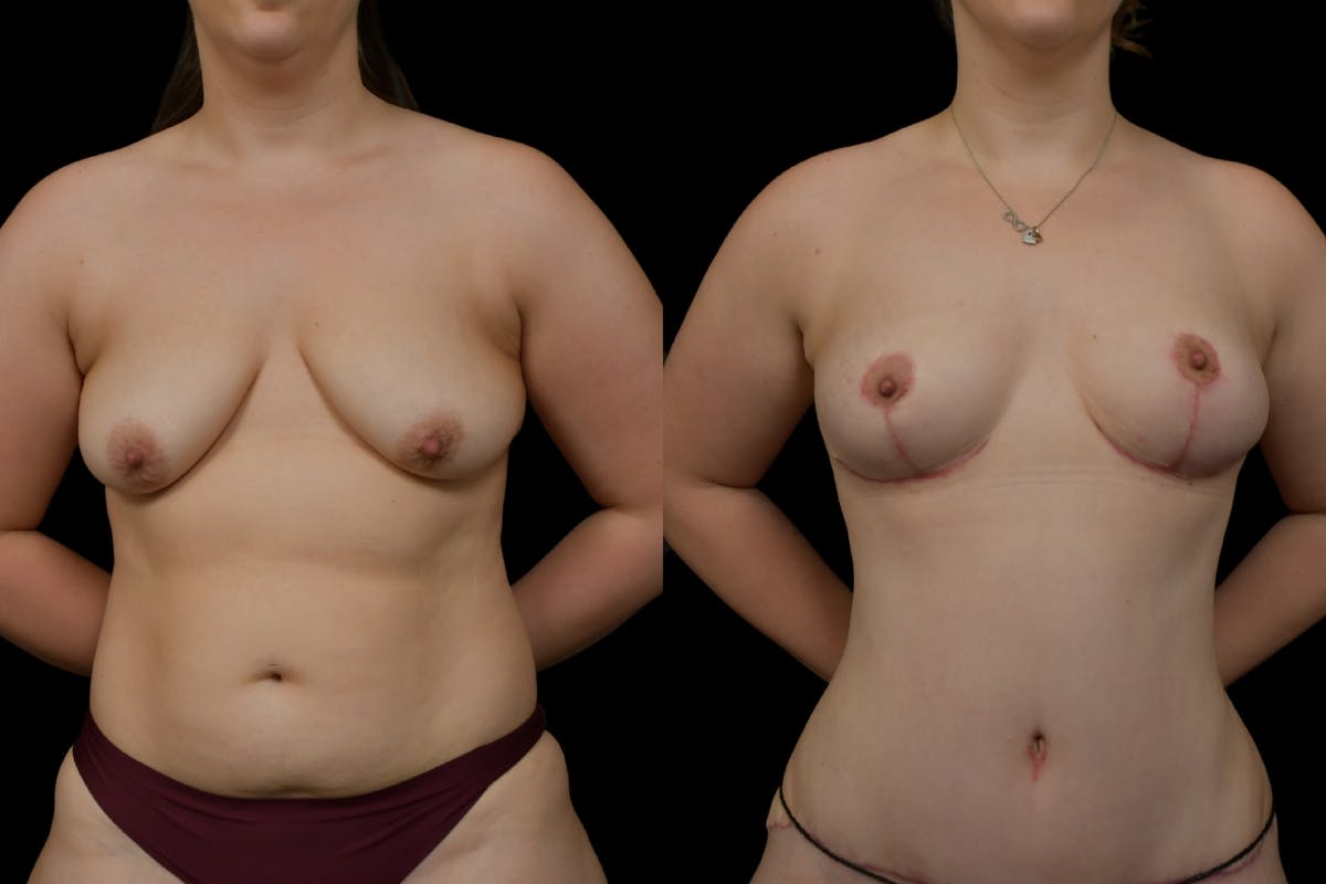 Breast Lift Before & After Gallery - Patient 379193 - Image 1