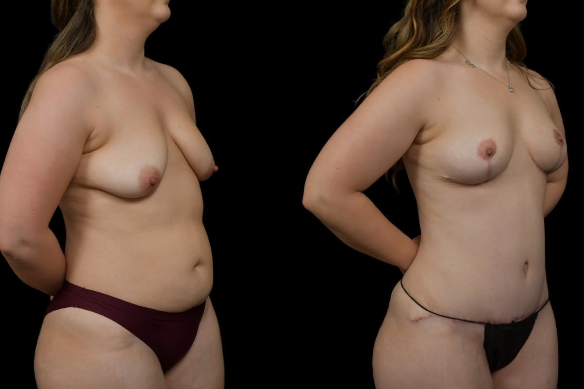 Breast Lift Before & After Gallery - Patient 379193 - Image 2
