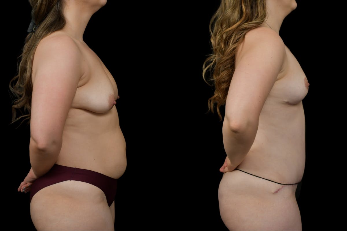 Breast Lift Before & After Gallery - Patient 379193 - Image 3