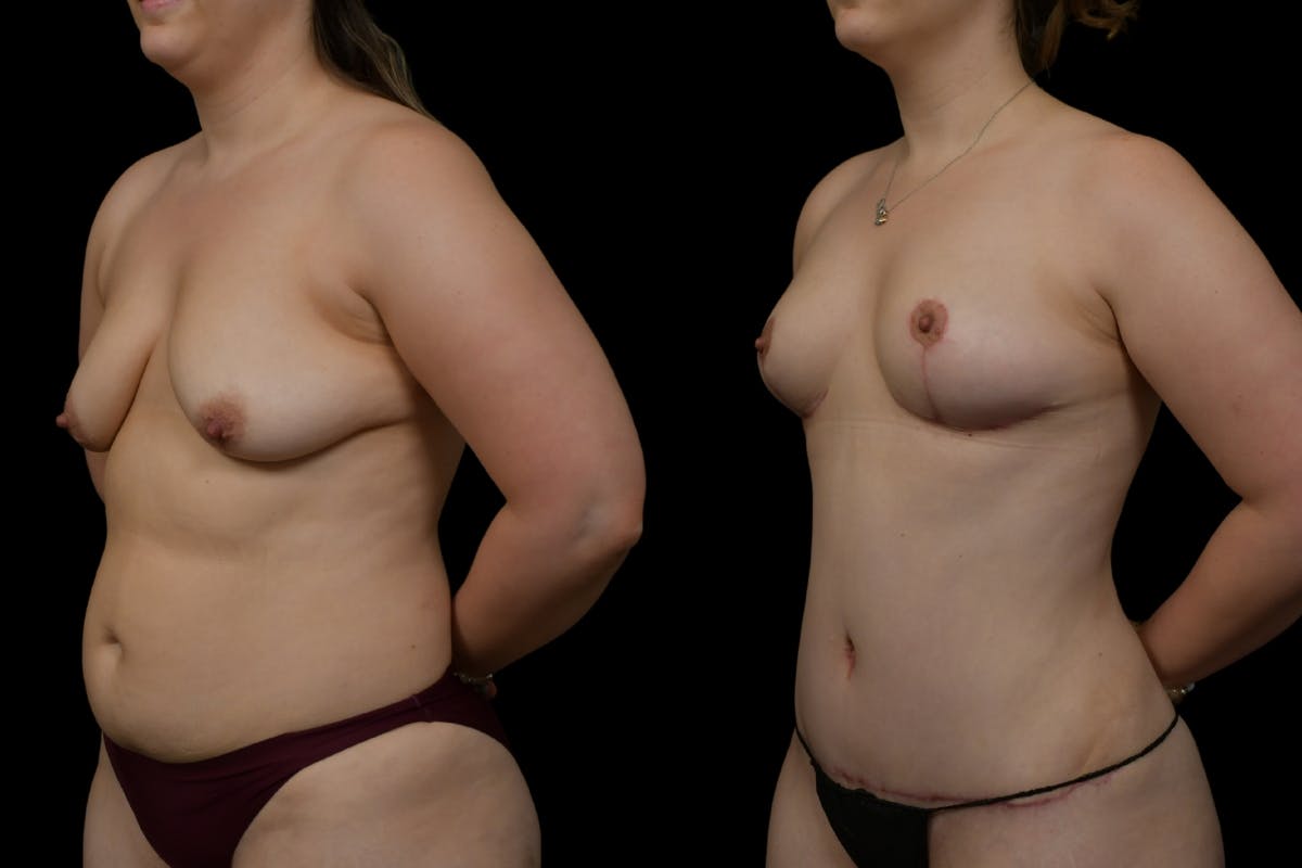 Breast Lift Before & After Gallery - Patient 379193 - Image 4