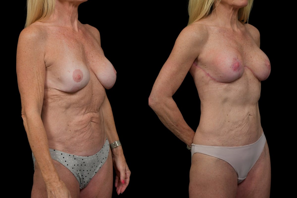 Tummy Tuck Before & After Gallery - Patient 256190 - Image 2