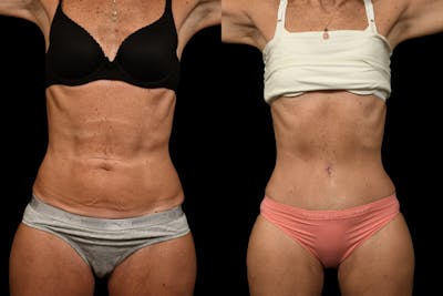 Tummy Tuck Before & After Gallery - Patient 344344 - Image 1