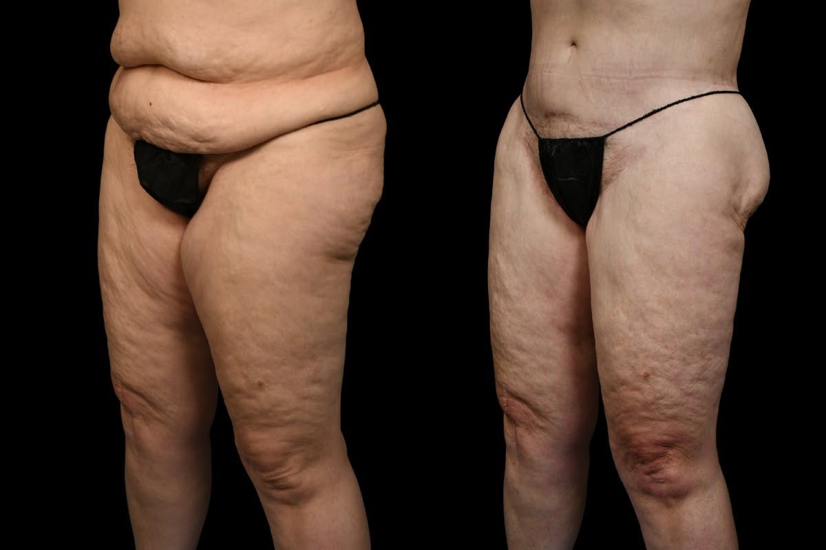 Thigh Lift Before & After Gallery - Patient 105130 - Image 3