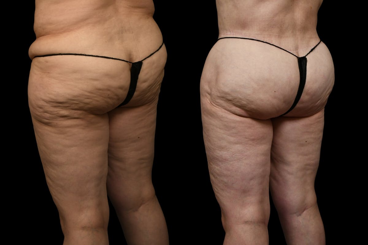 Thigh Lift Before & After Gallery - Patient 105130 - Image 5