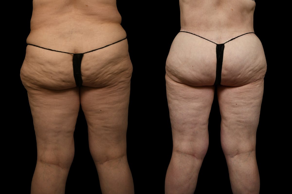 Thigh Lift Before & After Gallery - Patient 105130 - Image 2
