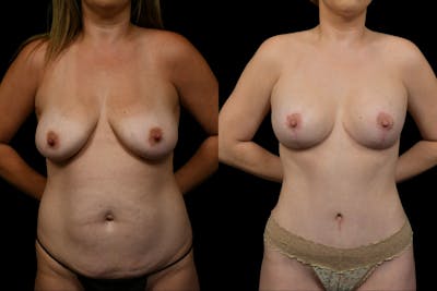 Mommy Makeover Before & After Gallery - Patient 312766 - Image 1