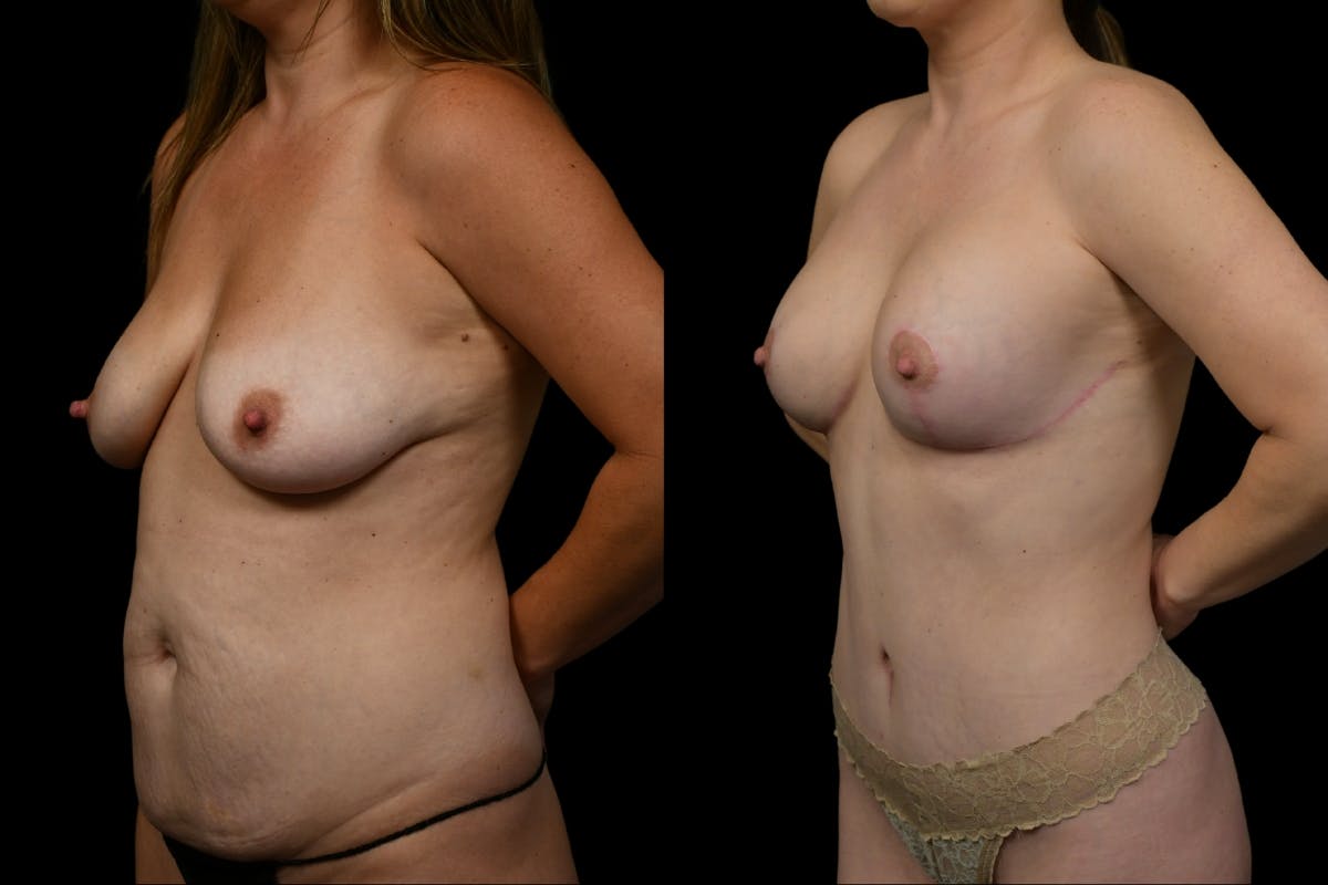 Mommy Makeover Before & After Gallery - Patient 312766 - Image 2