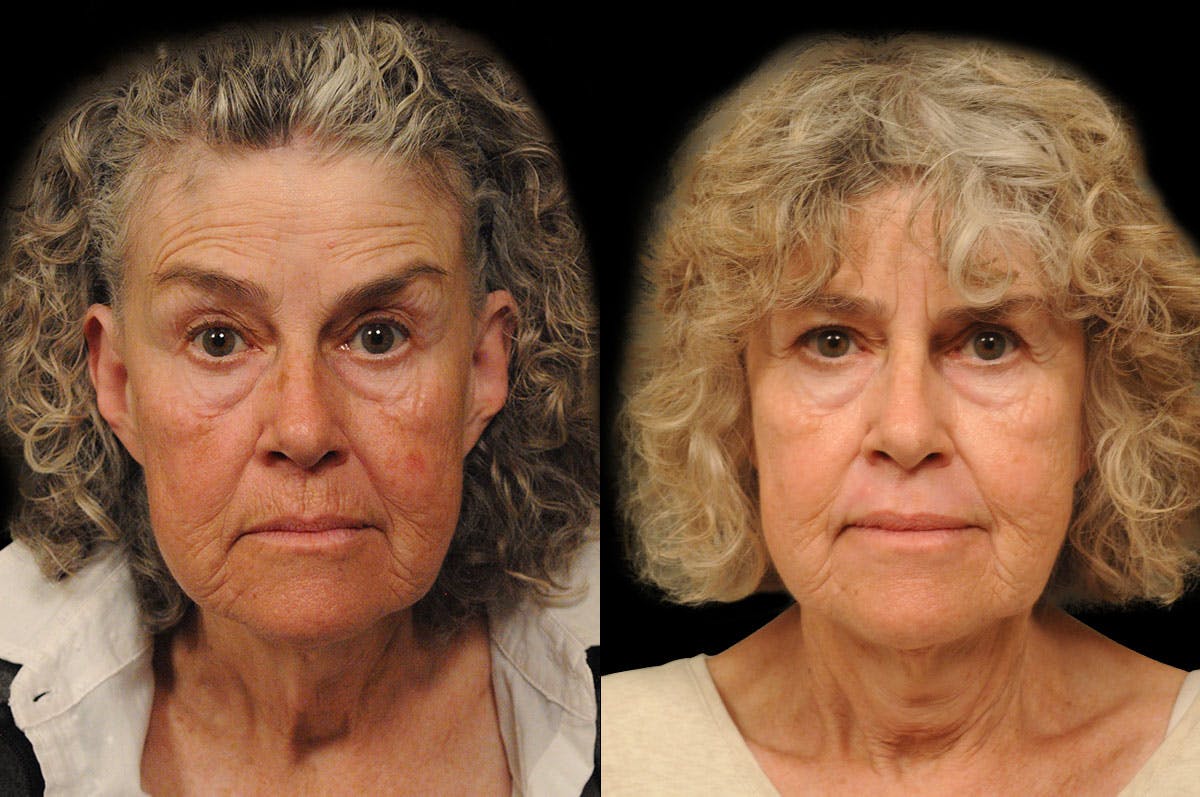 Perioral Dermabrasion Before & After Gallery - Patient 164871 - Image 1