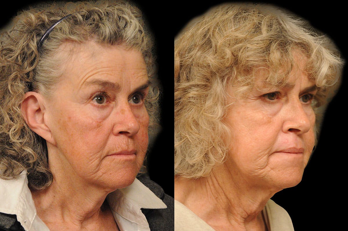 Perioral Dermabrasion Before & After Gallery - Patient 164871 - Image 2
