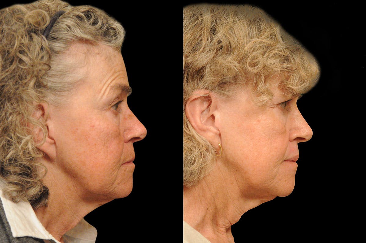 Perioral Dermabrasion Before & After Gallery - Patient 164871 - Image 3