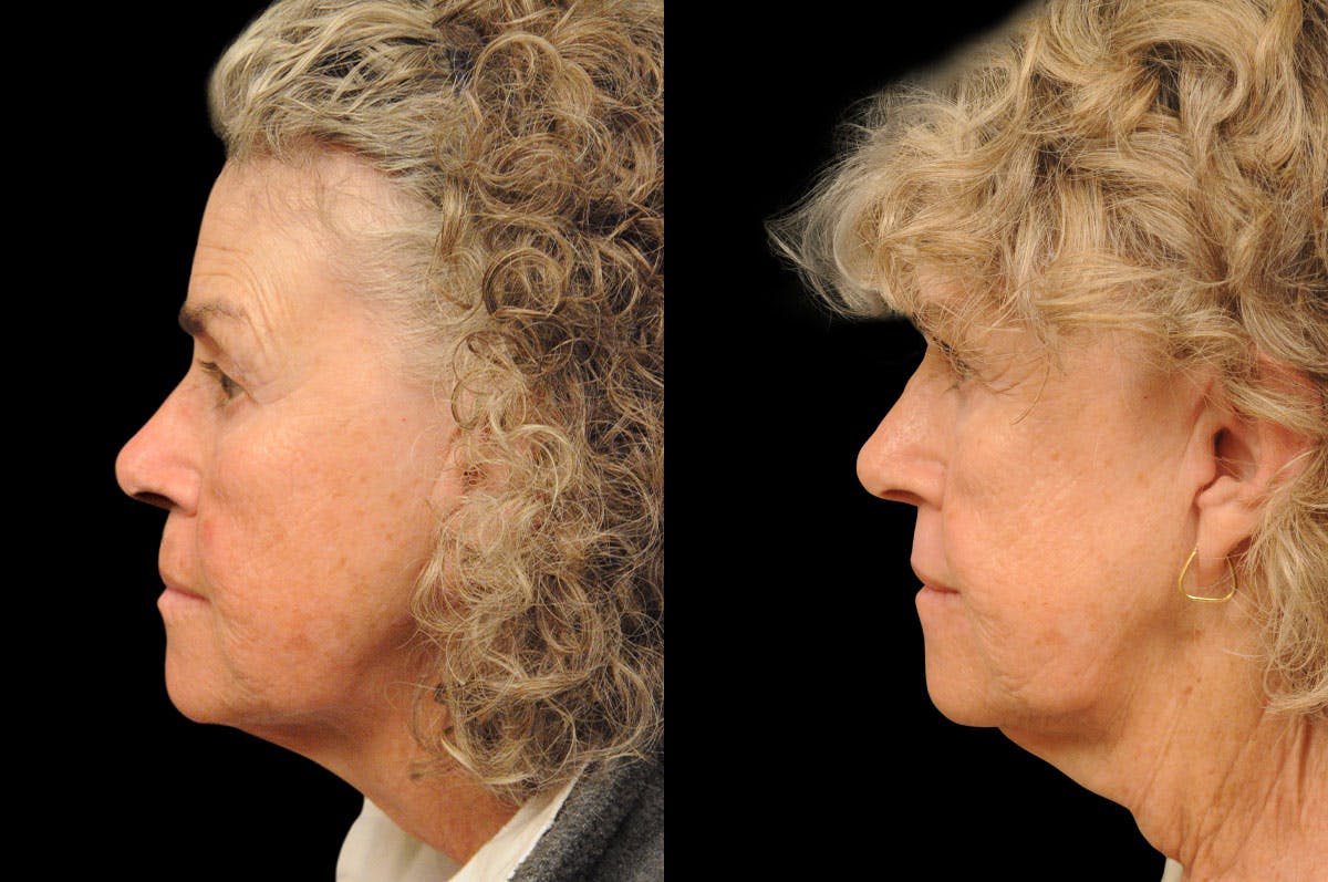 Perioral Dermabrasion Before & After Gallery - Patient 164871 - Image 5
