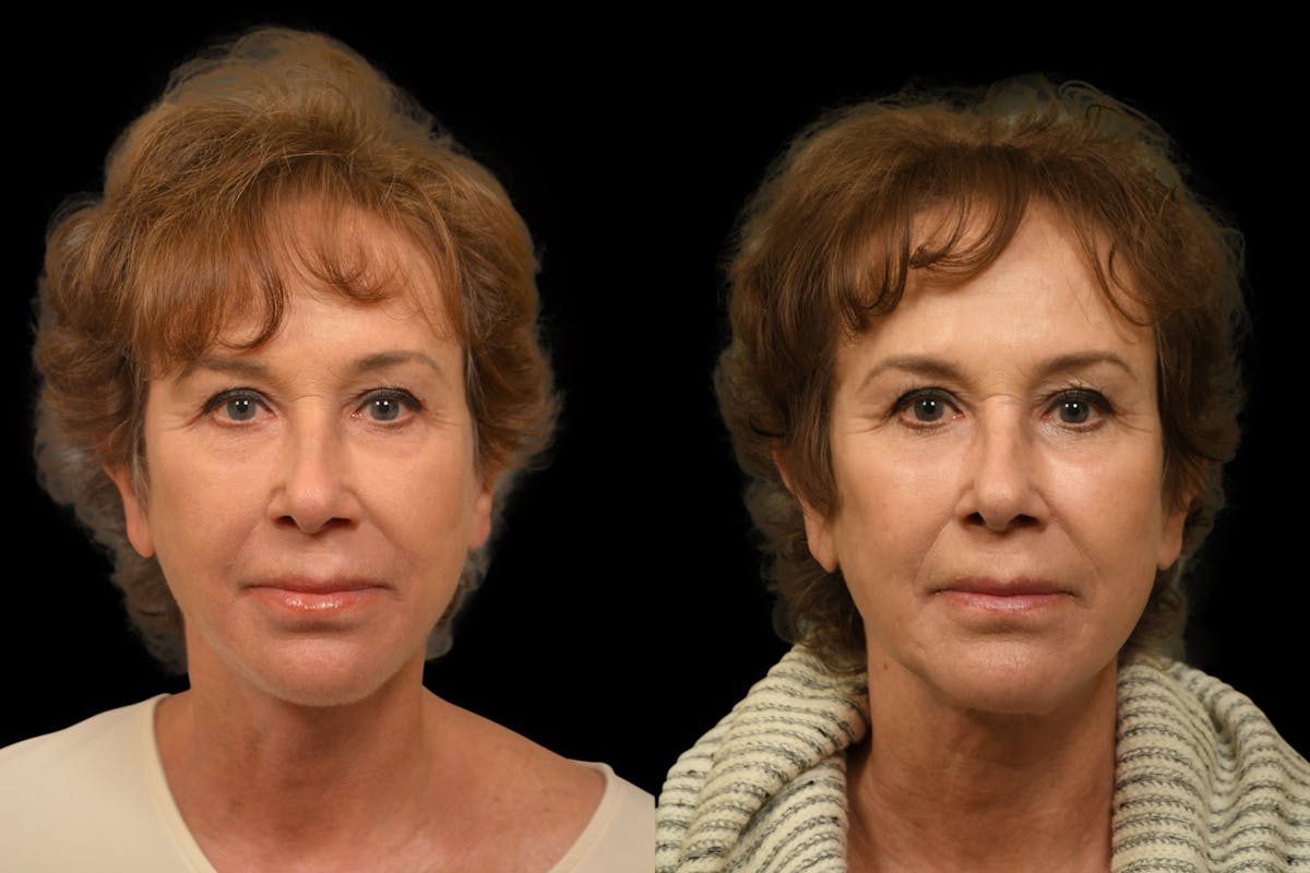 Perioral Dermabrasion Before & After Gallery - Patient 209734 - Image 1