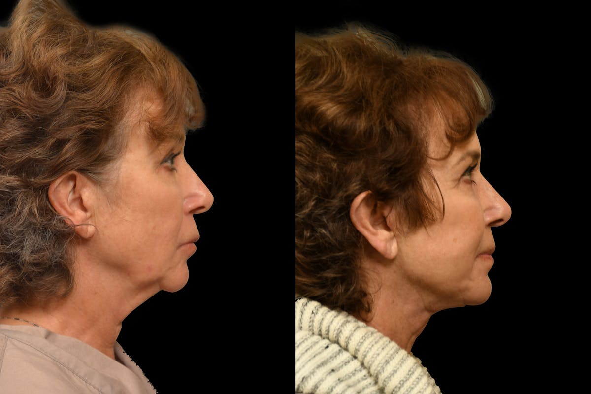 Perioral Dermabrasion Before & After Gallery - Patient 209734 - Image 3