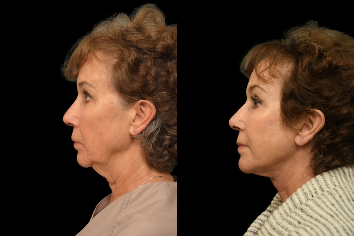 Perioral Dermabrasion Before & After Gallery - Patient 209734 - Image 5