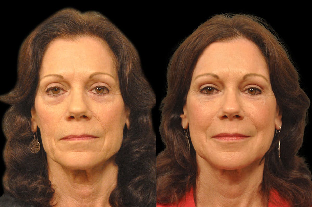 Perioral Dermabrasion Before & After Gallery - Patient 366883 - Image 1