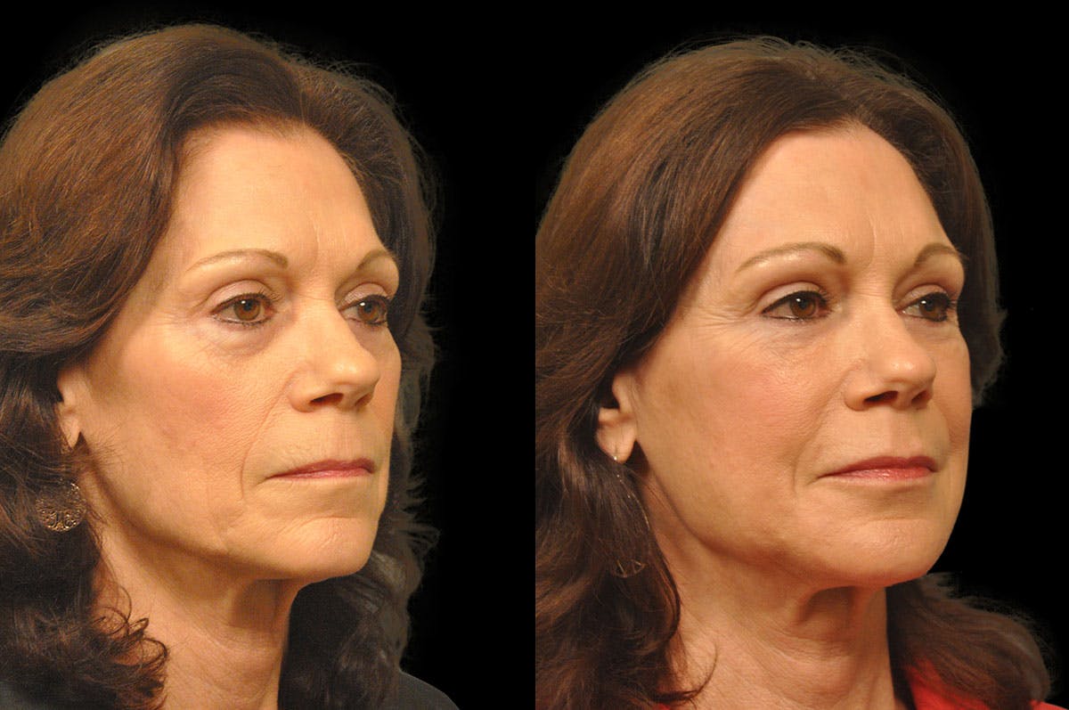 Perioral Dermabrasion Before & After Gallery - Patient 366883 - Image 2