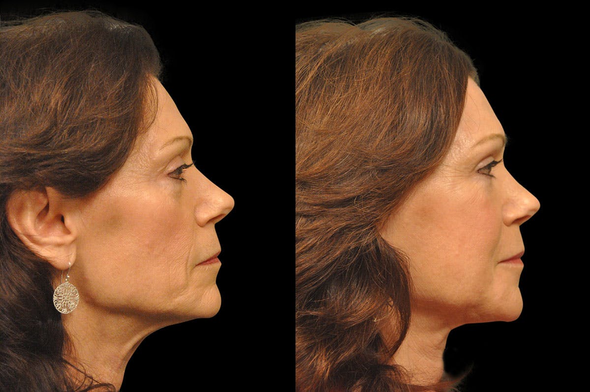 Perioral Dermabrasion Before & After Gallery - Patient 366883 - Image 3