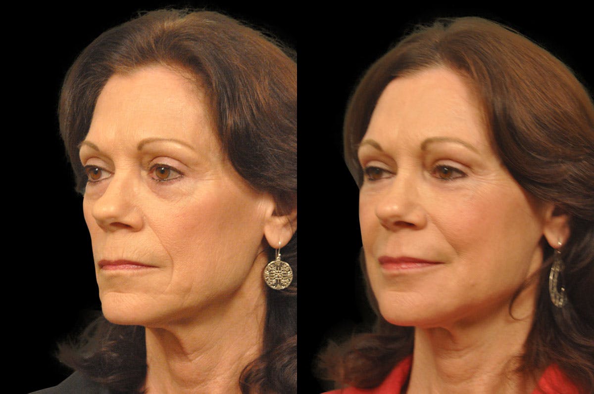 Perioral Dermabrasion Before & After Gallery - Patient 366883 - Image 4