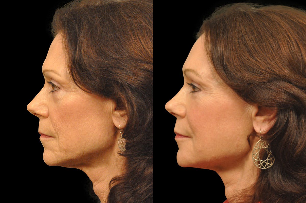 Perioral Dermabrasion Before & After Gallery - Patient 366883 - Image 5
