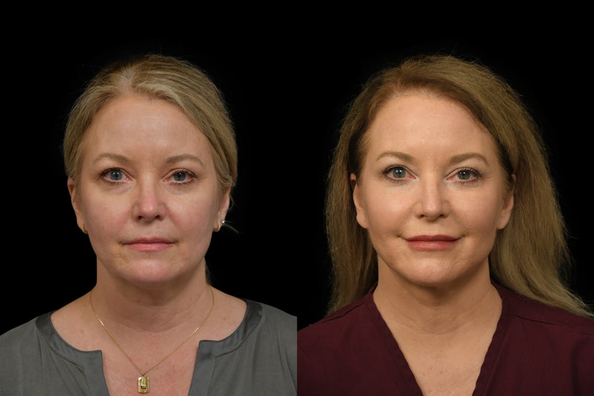 Neck Lift Before & After Gallery - Patient 414888 - Image 5