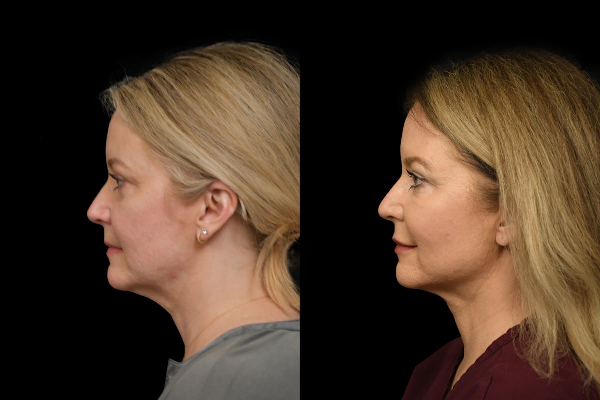 Neck Lift Before & After Gallery - Patient 414888 - Image 2