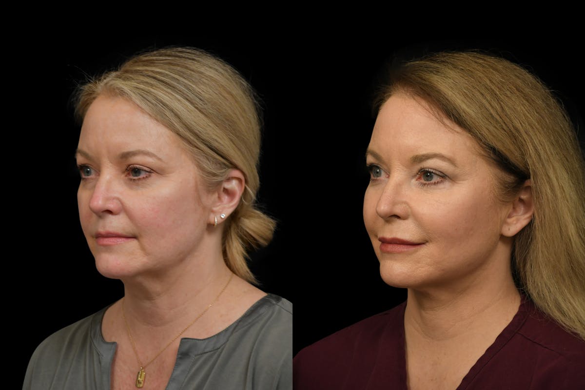 Neck Lift Before & After Gallery - Patient 414888 - Image 1