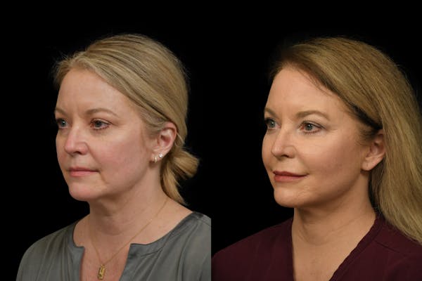 Neck Lift Before & After Gallery - Patient 414888 - Image 1